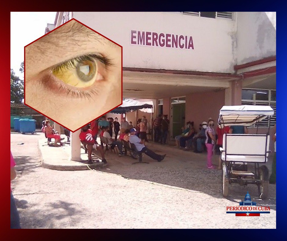 Brote de hepatitis en Ciego de Ávila genera alerta epidemiológica y preocupación ciudadana